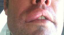 Poway Bee Removal Guy Anthony picture of swelling after being stung 
    on the lip.