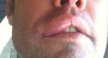 Oceanside Bee Removal Guy Anthony picture of swelling after being stung 
    on the lip.